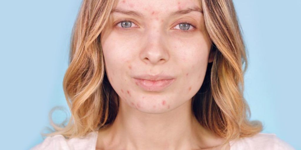 Misconceptions about acne 