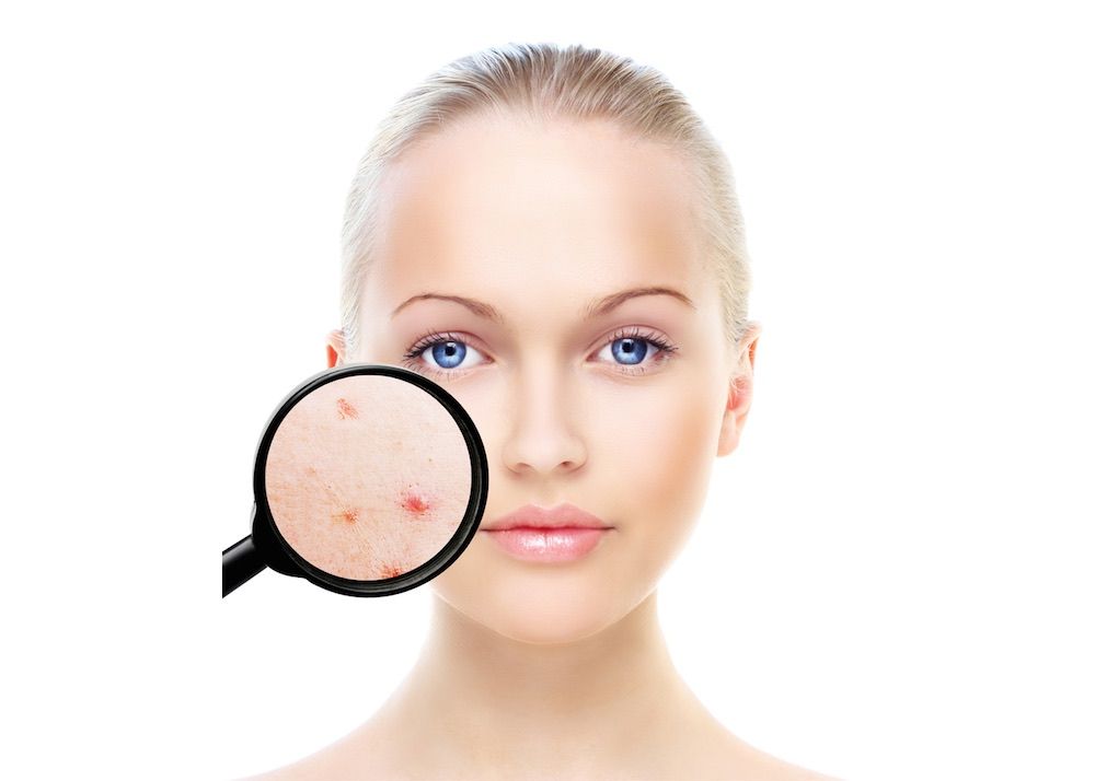Misconceptions about acne 