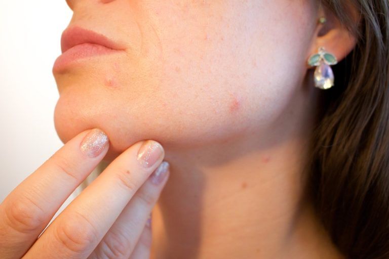 Acne problem