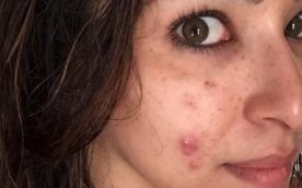 Misconceptions about acne