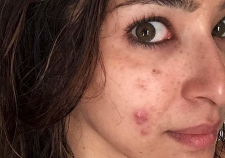 Misconceptions about acne