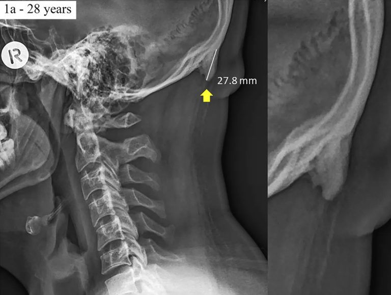Horns are Growing on Young People’s Skull!