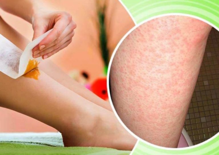 Ways to Treat Bumps after Waxing 