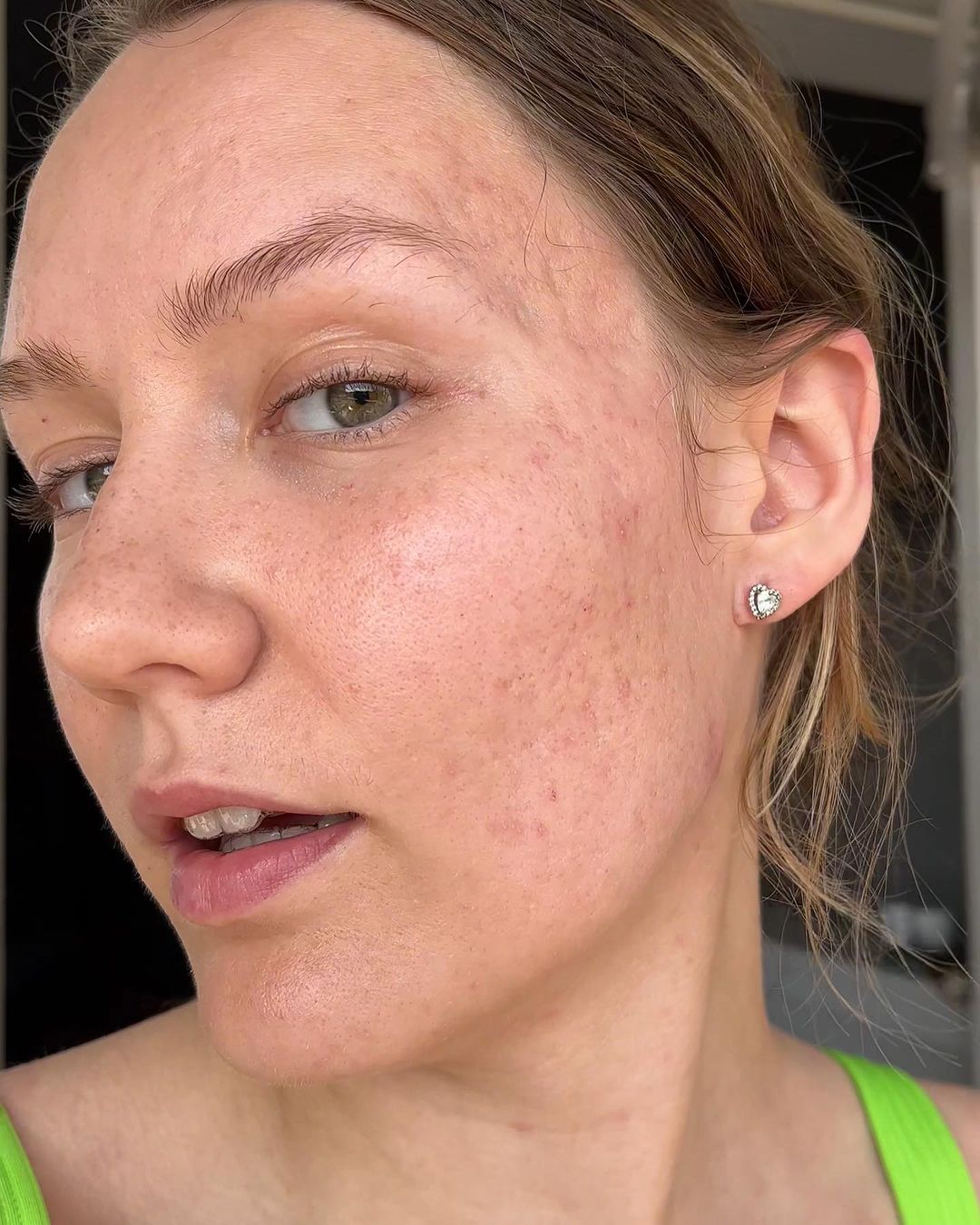 Dry-Acne-Prone-Skin