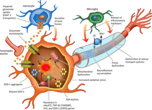  Amyotrophic-Lateral-Sclerosis