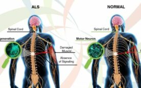 Amyotrophic-Lateral-Sclerosis
