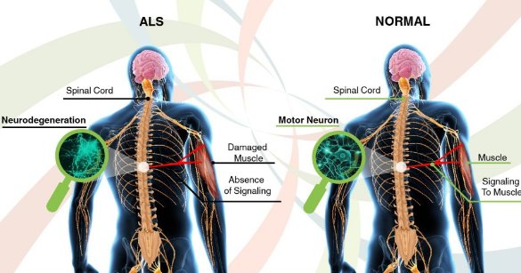 Amyotrophic-Lateral-Sclerosis