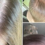 Mirena-Hair-Loss