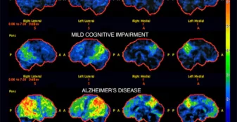 Alzheimer's-Progression