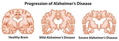 Alzheimer's Progression
