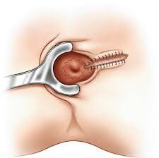 Fistulotomy