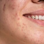 Staph-Pimples